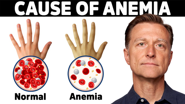 4 Jenis Pengobatan Alami Untuk Mengatasi Anemia